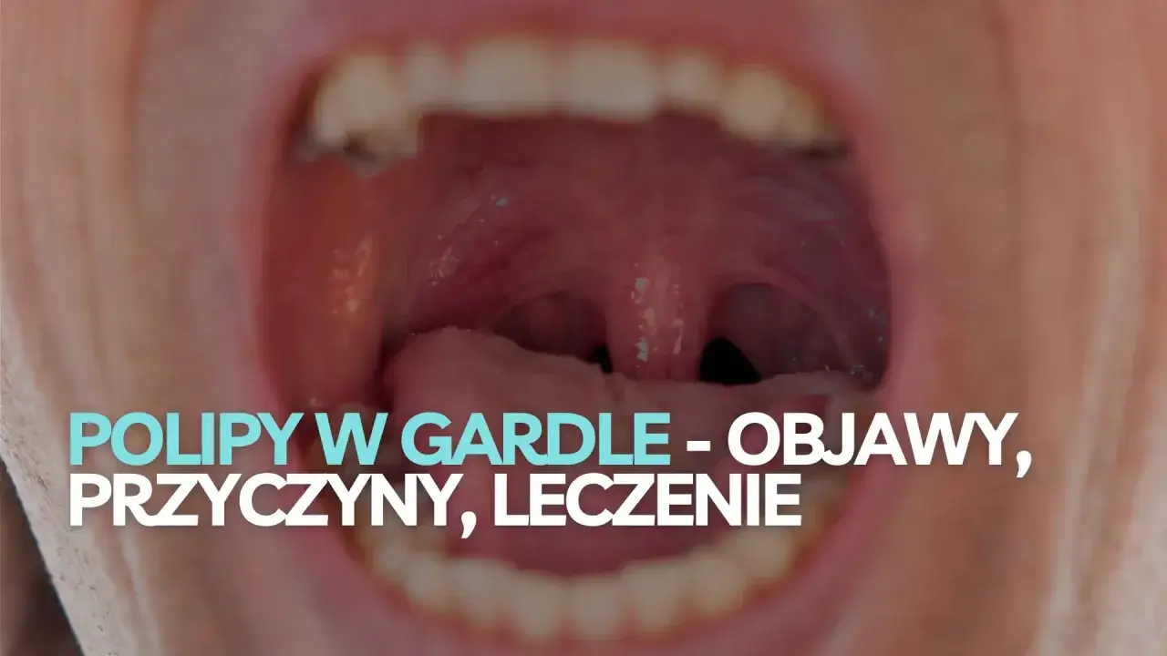 Widok otwartych ust z widocznymi migdałkami i językiem. Tekst informuje o polipach w gardle, objawach i leczeniu.