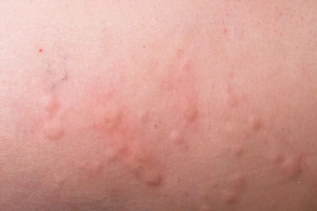 Hud med r&ouml;da, upph&ouml;jda utslag. Kan vara ett tecken p&aring; stress utslag.