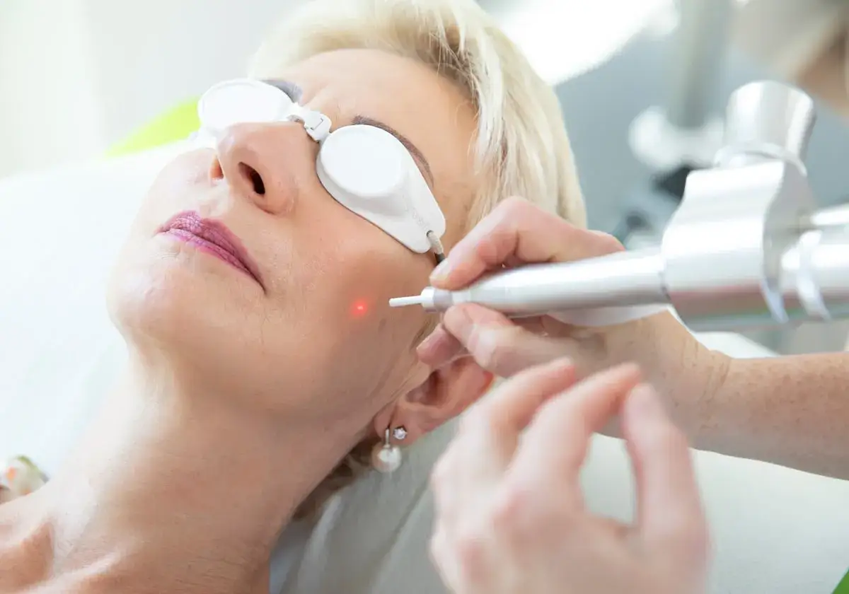 Frau mit Schutzbrille erhält Laserbehandlung gegen besenreiser im gesicht. Ein roter Punkt zeigt die Behandlungsstelle.
