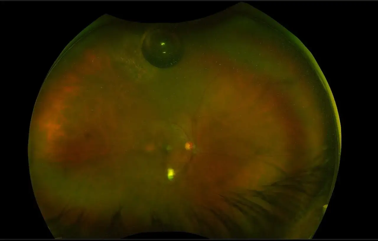 Vista retinica post-vitrectomia con bolla d'aria visibile in alto, che aiuta a riposizionare la retina.