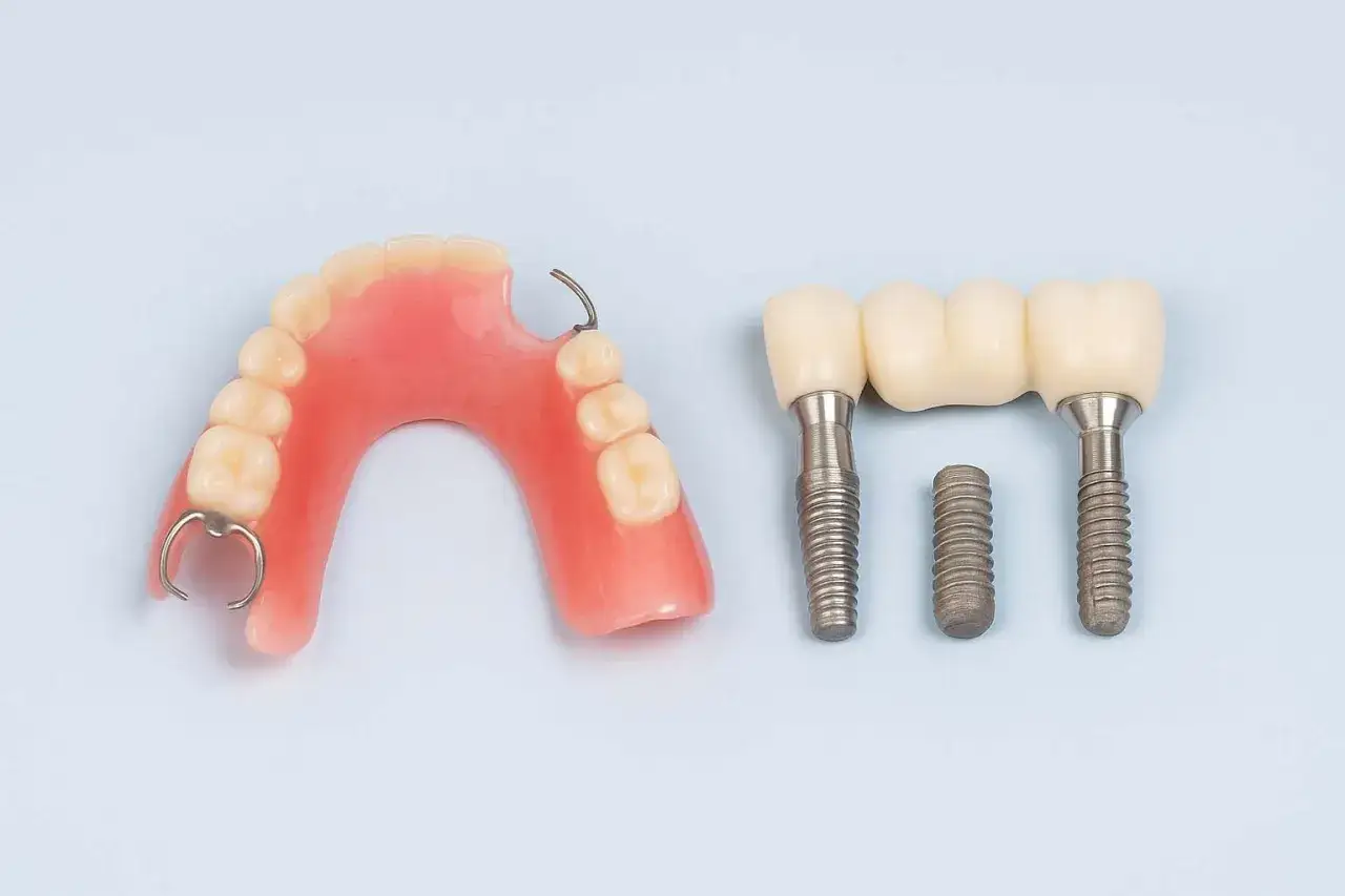 Proteza częściowa i most na implantach – alternatywy dla brakujących zębów.