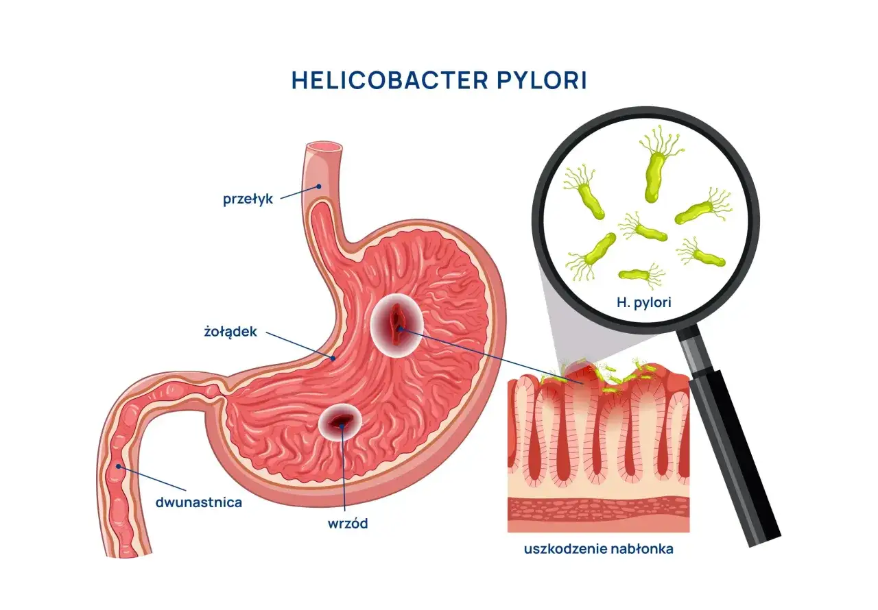 Przekrój żołądka z wrzodami i bakteriami Helicobacter pylori. Powiększenie ukazuje H. pylori uszkadzające nabłonek. Leczenie może obejmować bizmut.