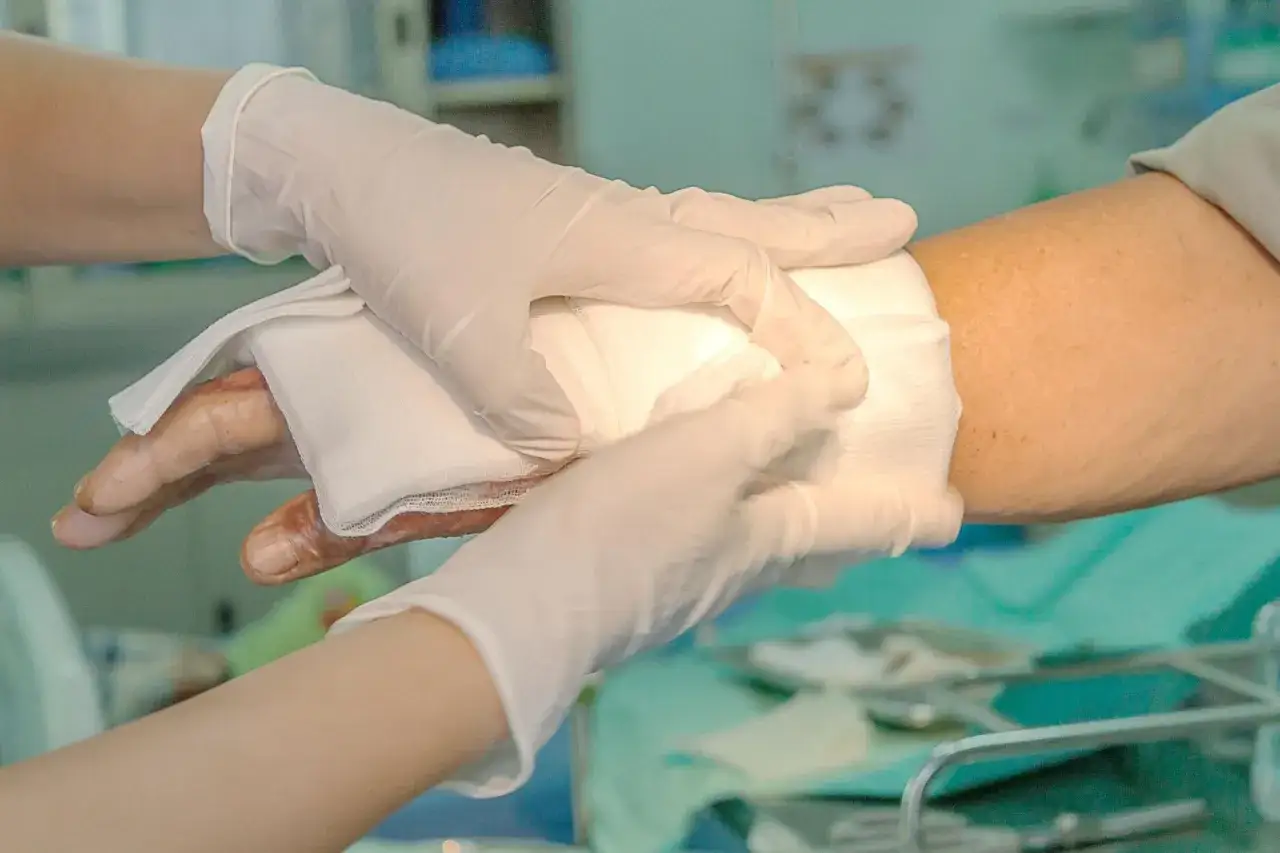 Ręce w rękawiczkach opatrują oparzenie na dłoni. W ciąży oparzenie w ciąży co stosować – konsultacja lekarska kluczowa.