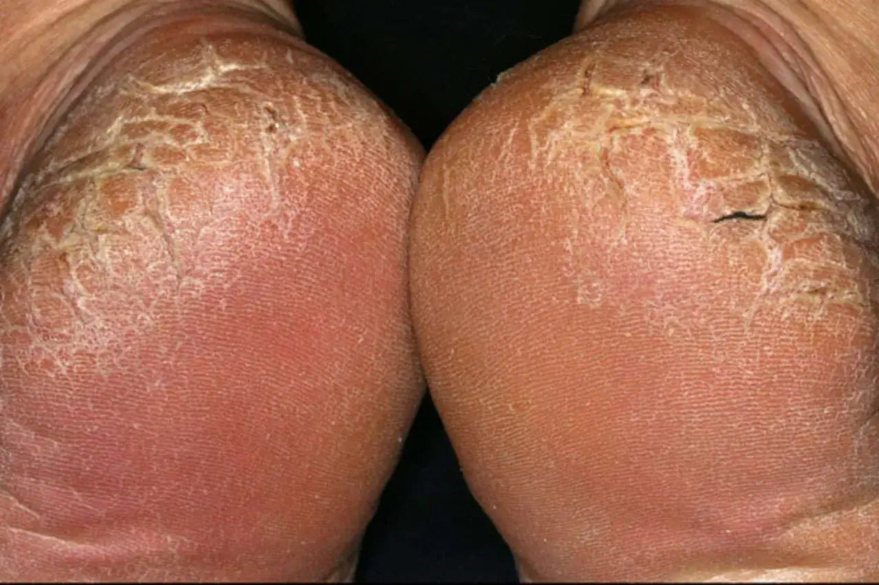 Gros plan sur deux talons de pied pr&eacute;sentant une peau tr&egrave;s s&egrave;che et craquel&eacute;e, formant une croute pied.