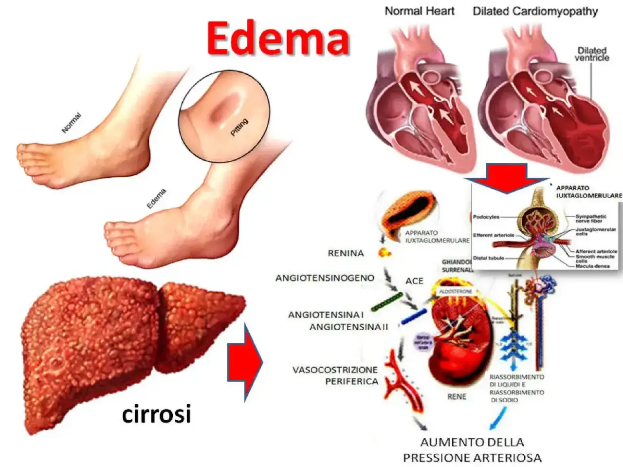 Edema ai piedi, cuore dilatato e fegato cirrotico: possibili cause di 10 kg di ritenzione idrica.