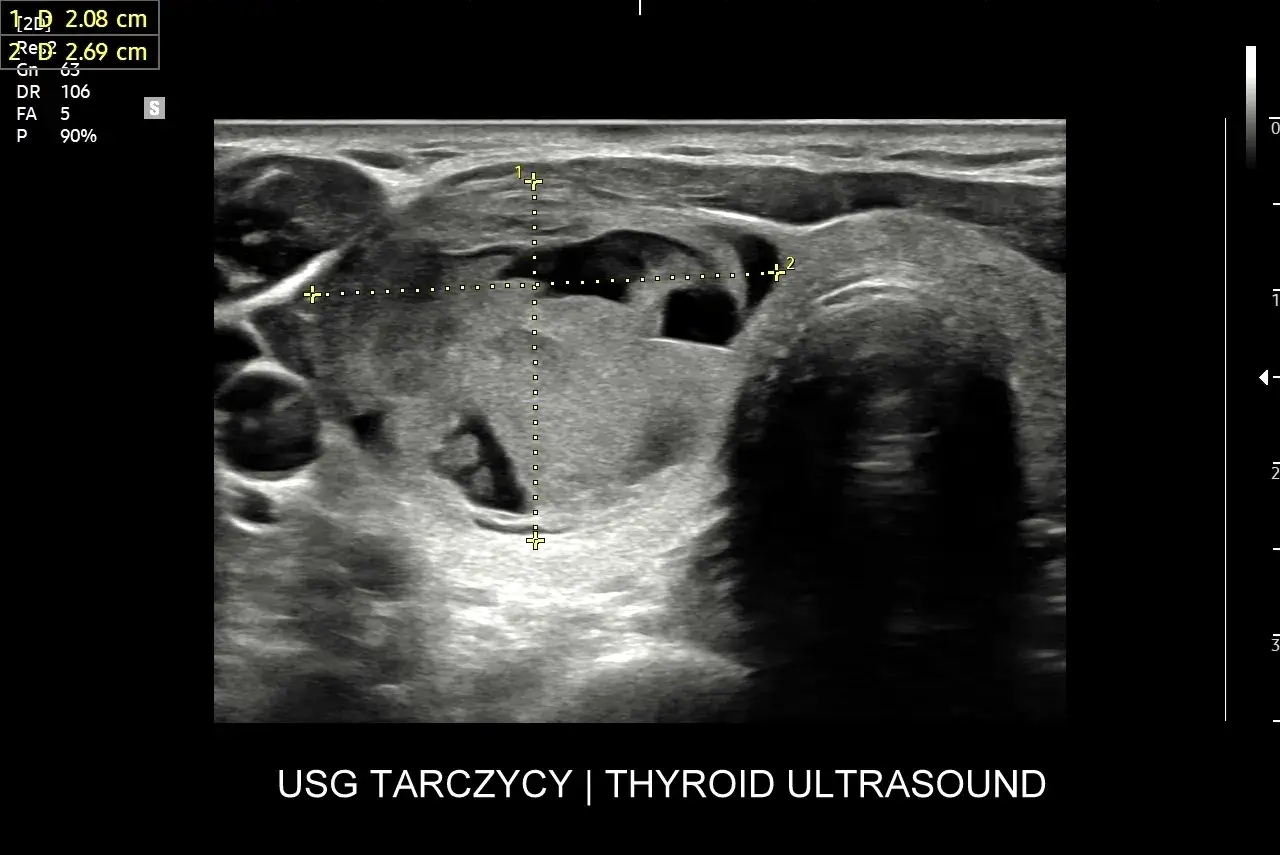 USG tarczycy pokazuje niejednorodną strukturę z widocznymi zmianami. To część diagnostyki, jakie badania na tarczycę są potrzebne.