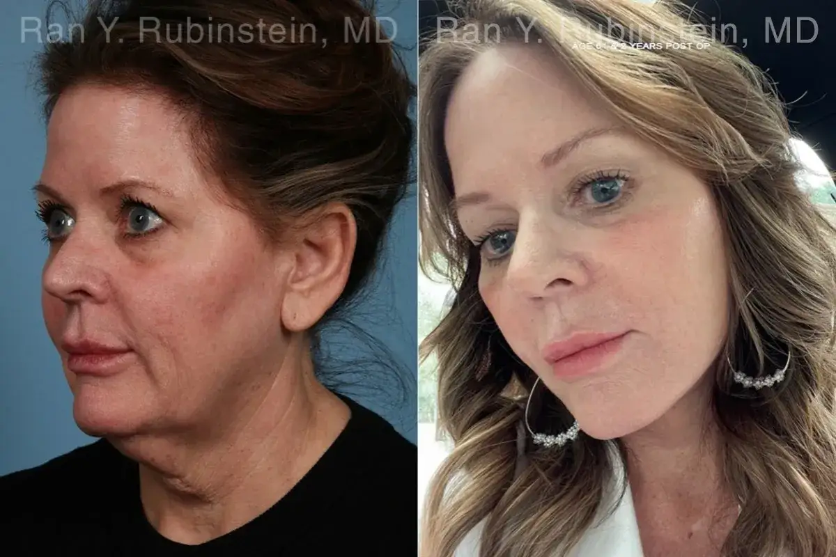 Antes y despu&eacute;s de un tratamiento para la flacidez facial a los 50. La imagen muestra una mejora notable en la firmeza y contorno del rostro.