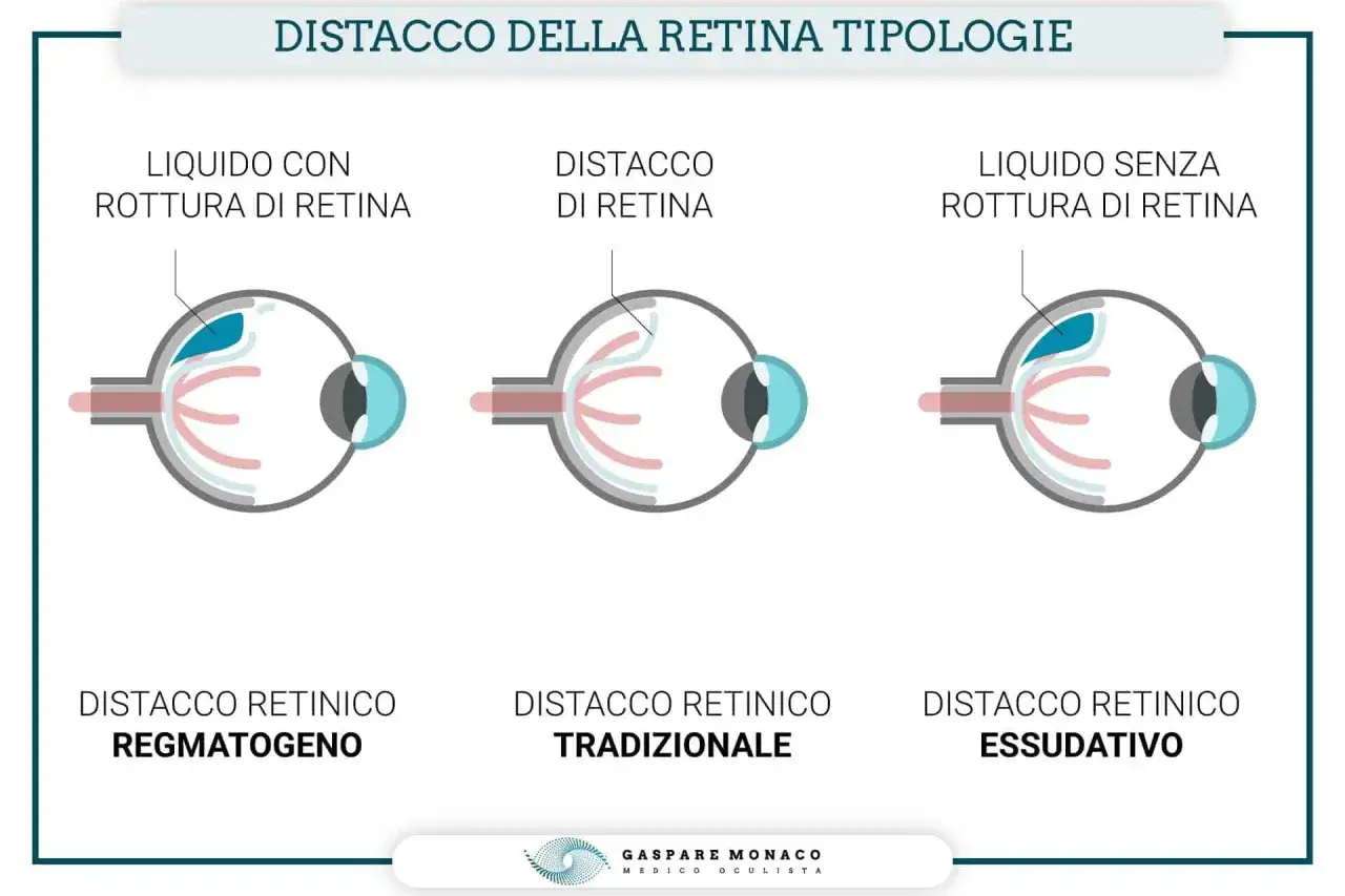 Illustrazione di tre tipi di distacco retinico: con rottura, tradizionale e essudativo. L'ombra nera dell'occhio è un sintomo visibile.