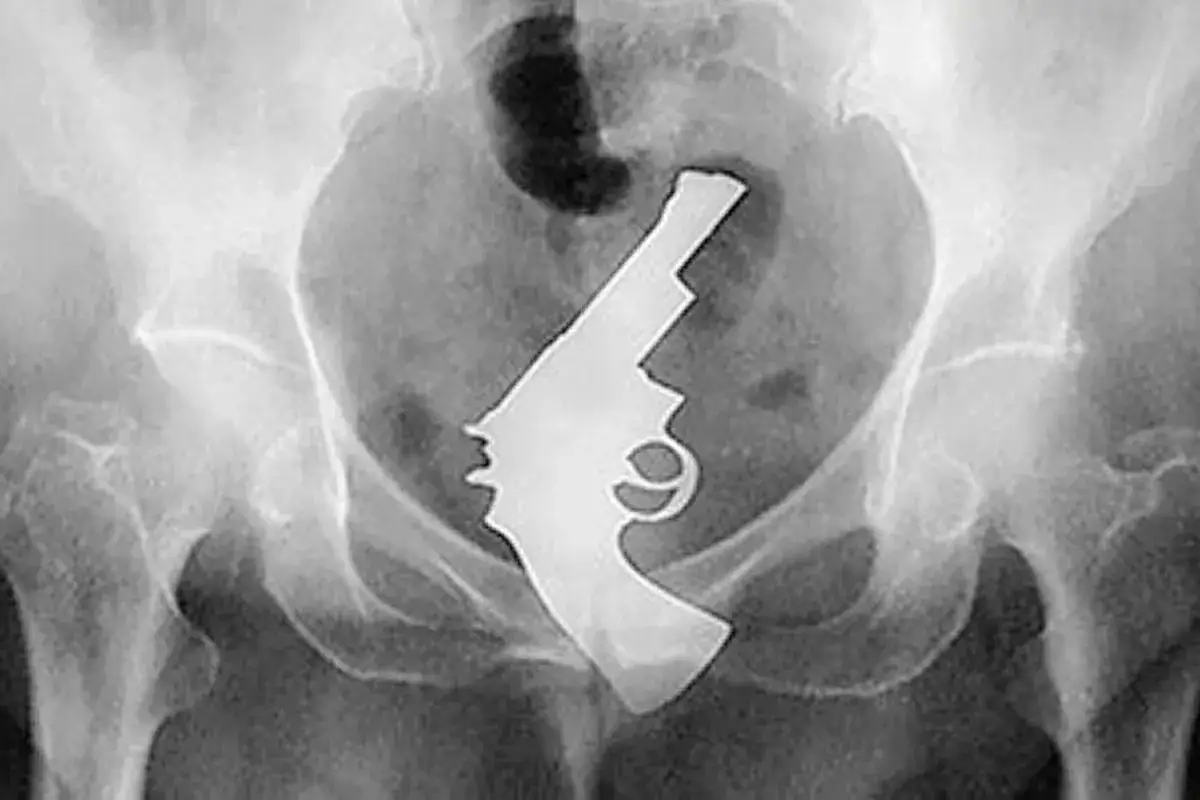 Radiographie pelvienne montrant un objet atypique, synonyme d'une situation des plus inhabituelles.