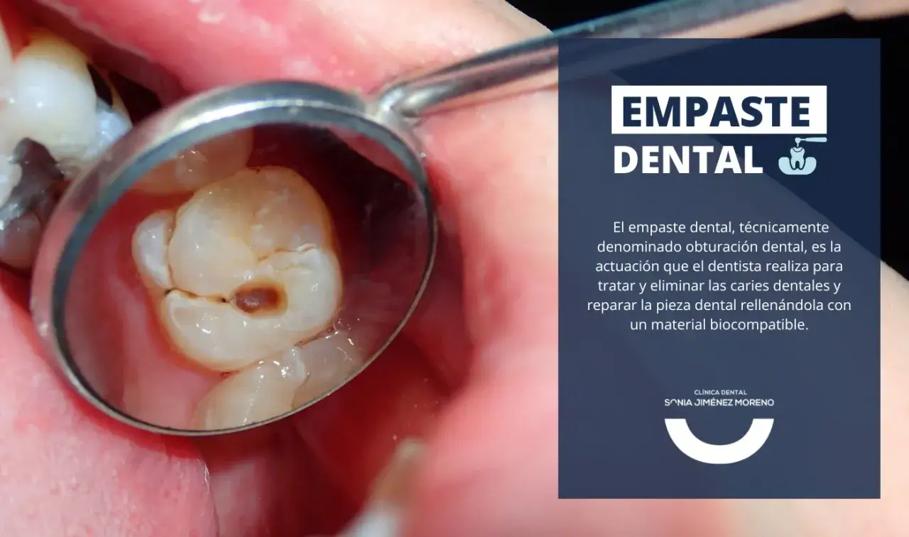 Un espejo dental refleja una muela con caries en dentina, mostrando la cavidad oscura.