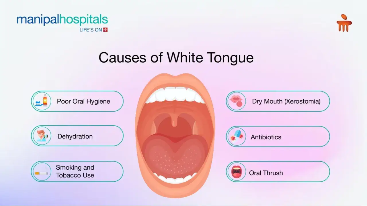 Ilustraci&oacute;n de boca abierta con causas de lengua blanca: mala higiene, deshidrataci&oacute;n, tabaco, boca seca, antibi&oacute;ticos y candidiasis.