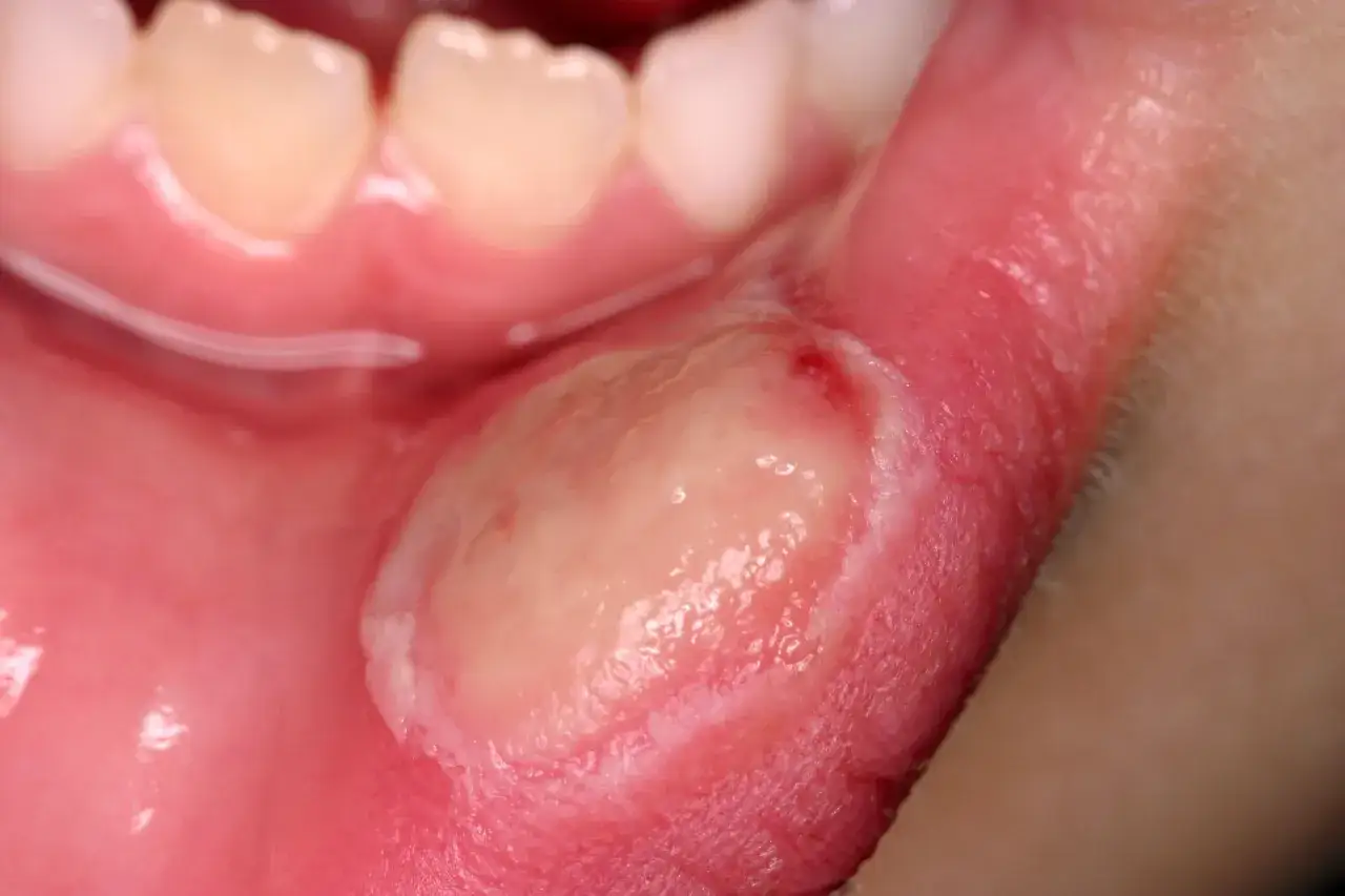 Gengiva arrossata con una grande aftosi major, dolorosa e con un'area eritematosa circostante.