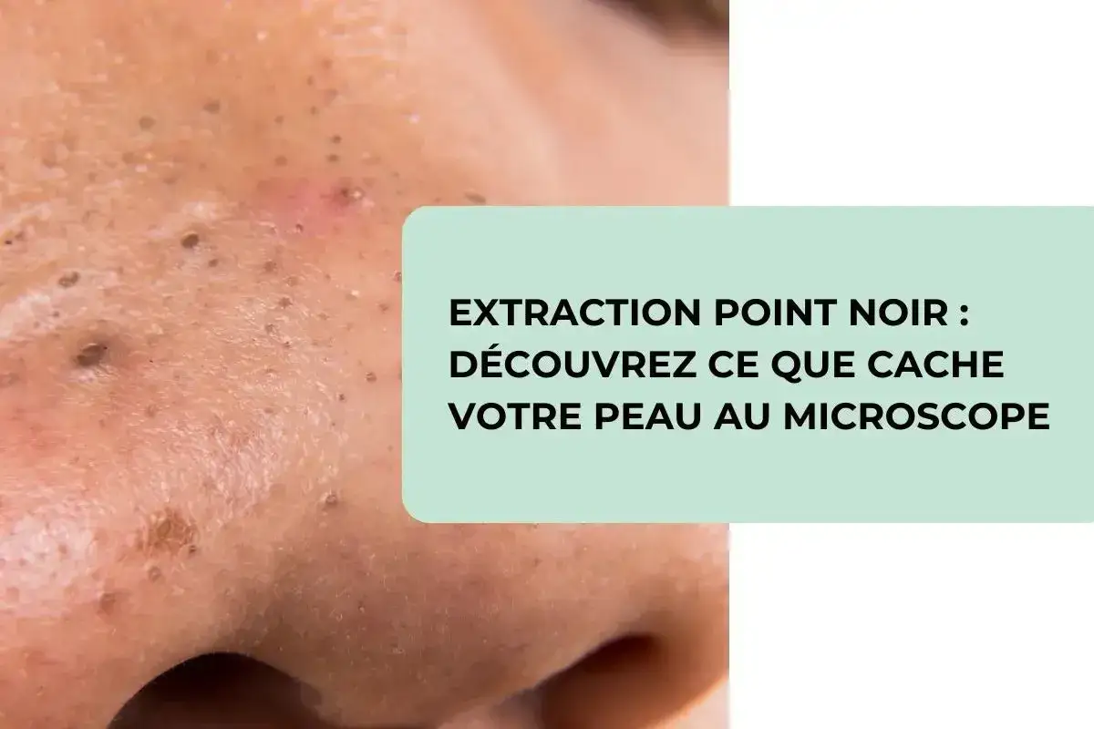 Gros plan sur une peau présentant des points noirs, avec un texte invitant à découvrir ce que cache votre peau au microscope lors d'une extraction de points noirs.