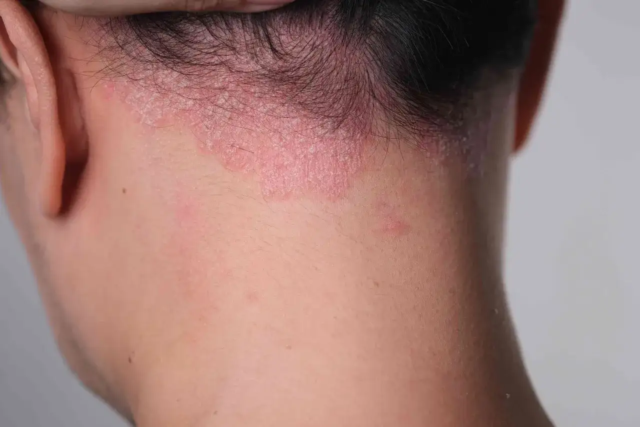 Sarpullido en el cuello, con piel enrojecida y escamosa, cubriendo parte de la nuca y detrás de la oreja.