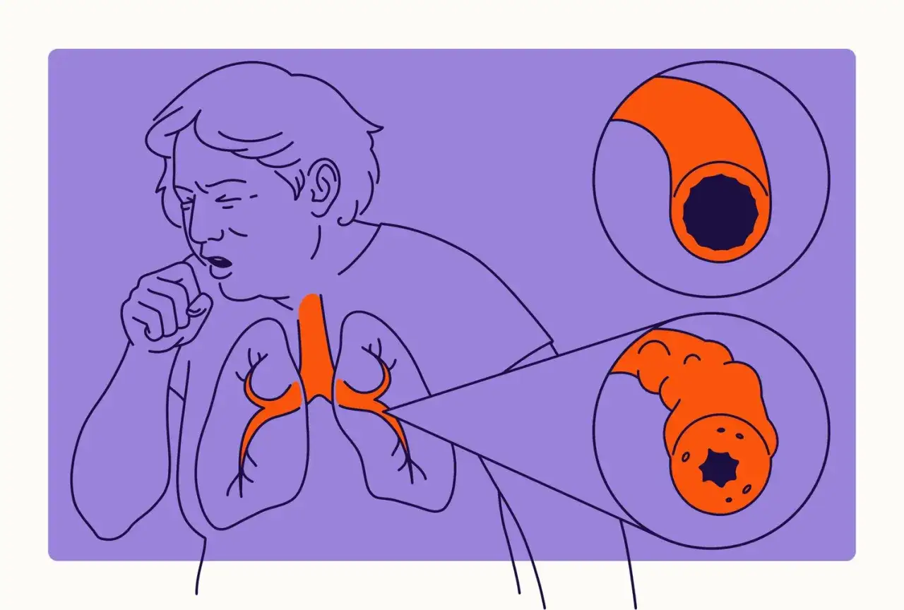 Illustration zeigt eine Person mit Husten und verengten Atemwegen, die eine chronisch obstruktive Lungenkrankheit mit akuter Exazerbation darstellt.