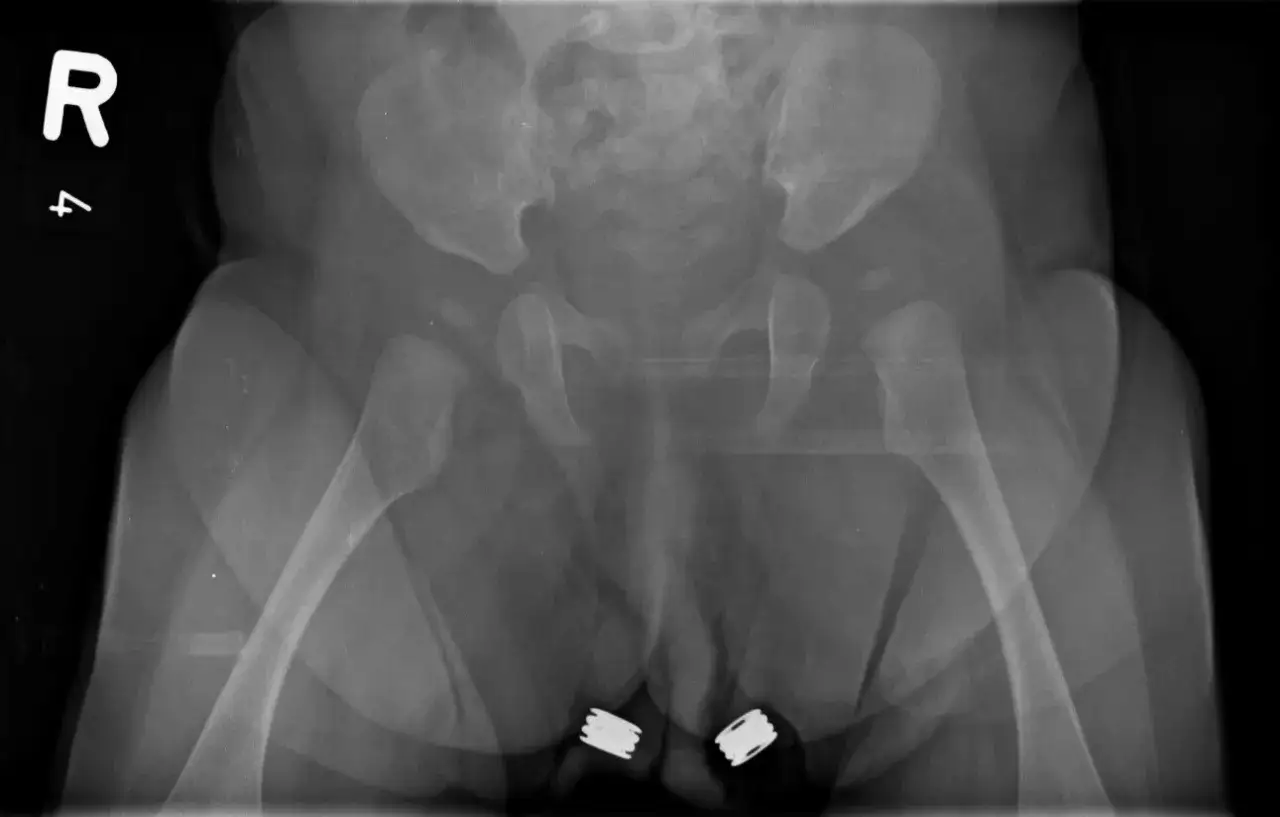 RTG miednicy z widocznymi implantami, sugerującymi późno wykrytą dysplazję stawu biodrowego.