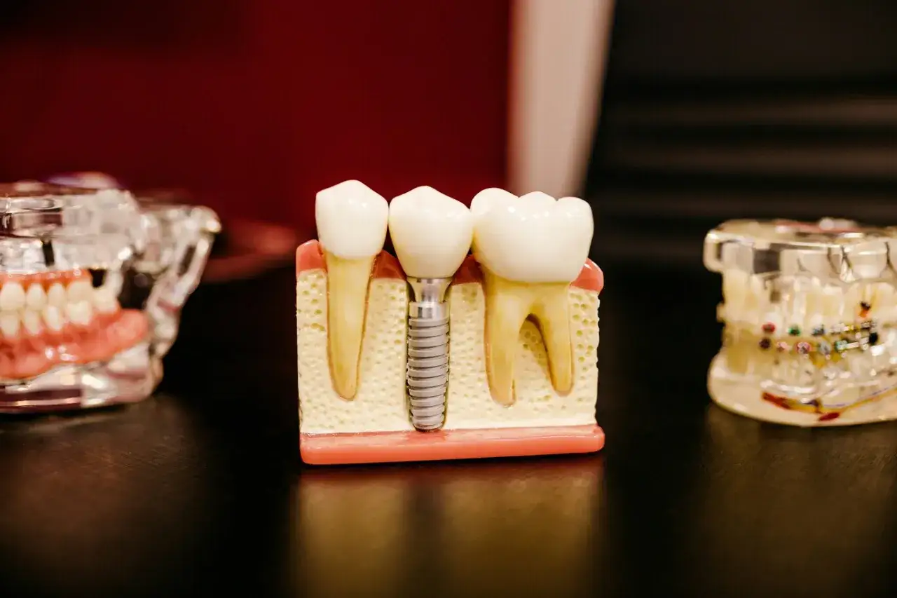 Model zęba z implantem i zębami, pokazujący co zamiast implantu.