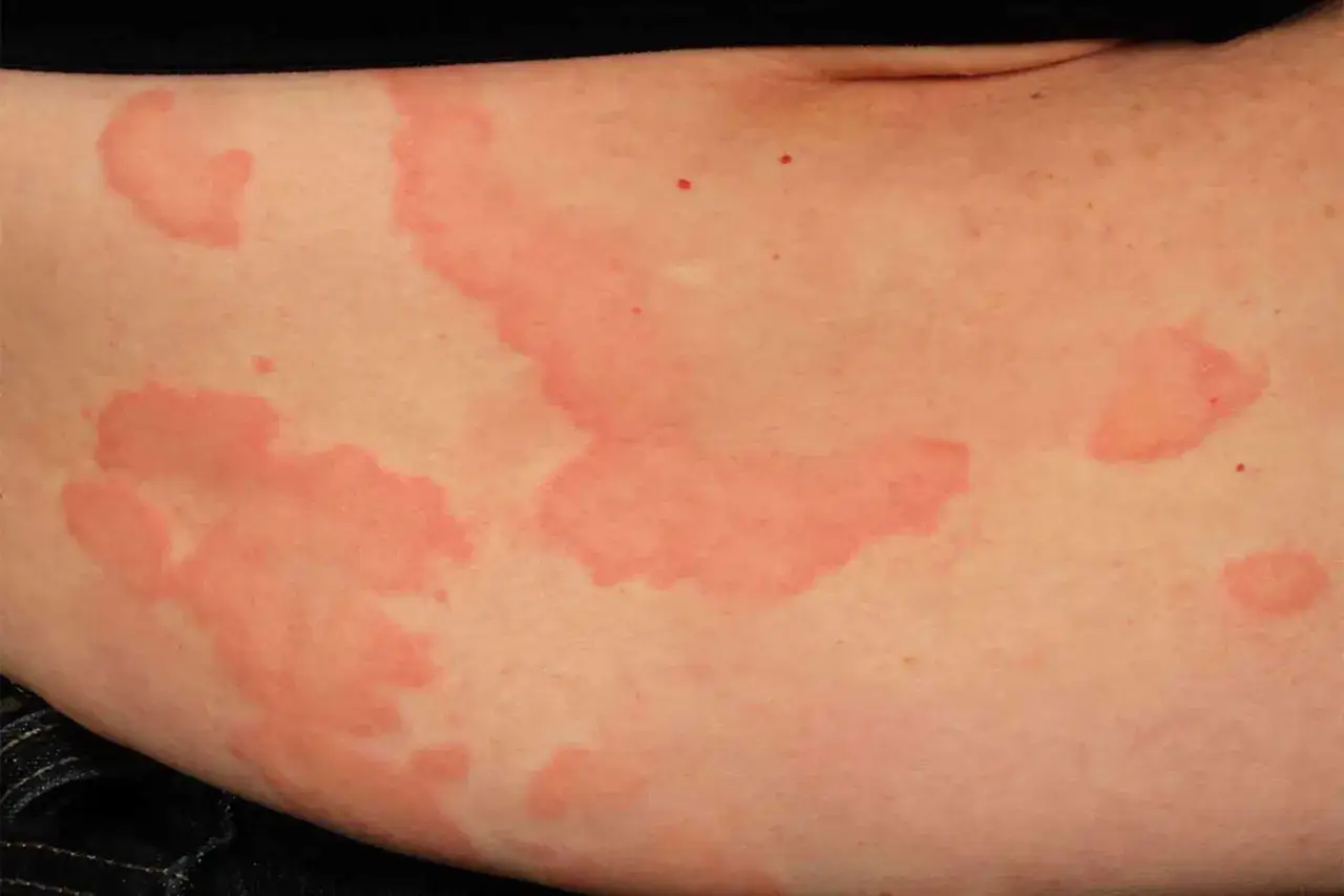 Rougeurs et plaques sur la peau, signes possibles de stress cutané.