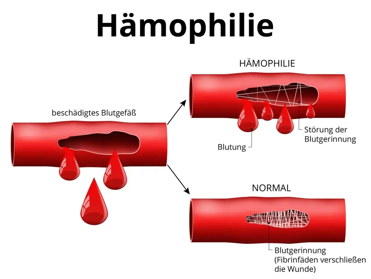 Zdjęcie H&auml;mophilie Diagnostik: Wichtige Schritte und Symptome, die Sie kennen sollten