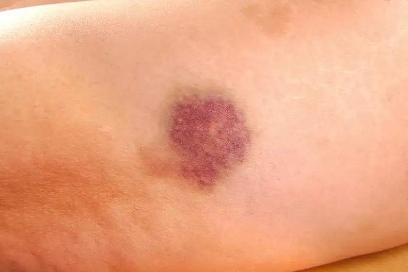 Zdjęcie Zaburzenia hematologiczne co to - objawy, przyczyny i leczenie