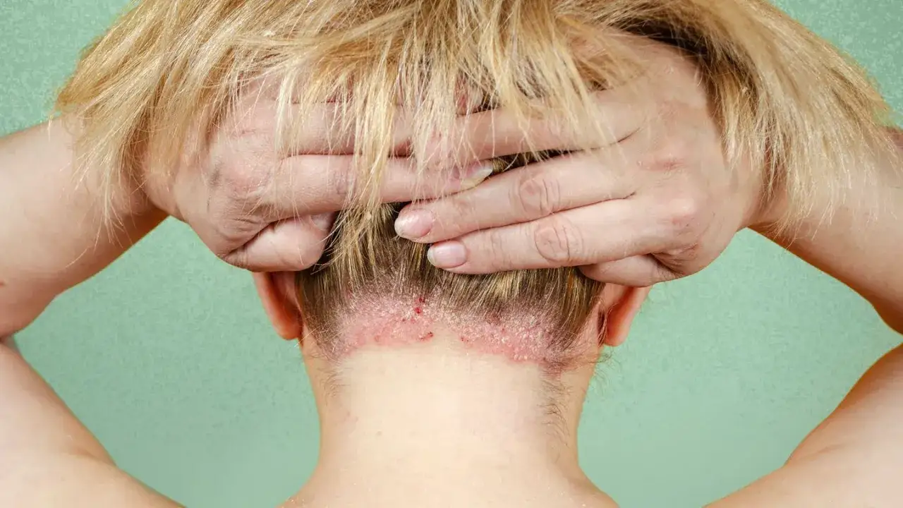 Vue arrière d'une personne aux cheveux blonds, mains dans les cheveux, montrant des squames sur le cuir chevelu et la nuque.