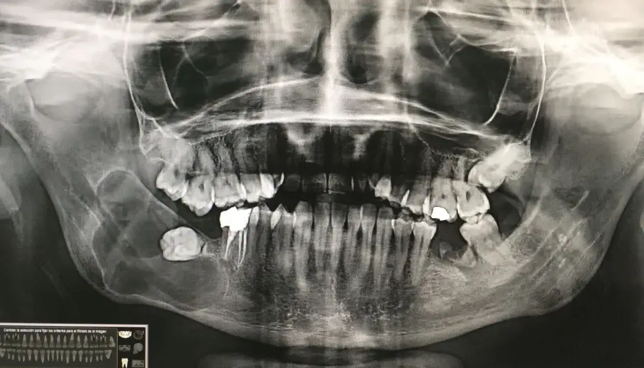 Radiograf&iacute;a panor&aacute;mica dental que muestra un quiste odontog&eacute;nico en la mand&iacute;bula izquierda, expandiendo el hueso y afectando la ra&iacute;z de un diente.