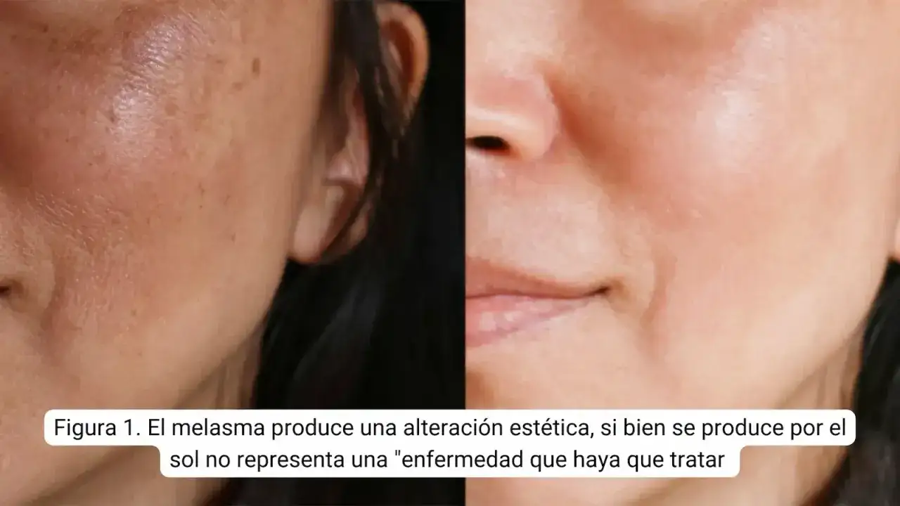 Comparación de piel con melasma y piel tratada. El ácido tranexámico para que sirve, ayuda a aclarar manchas.