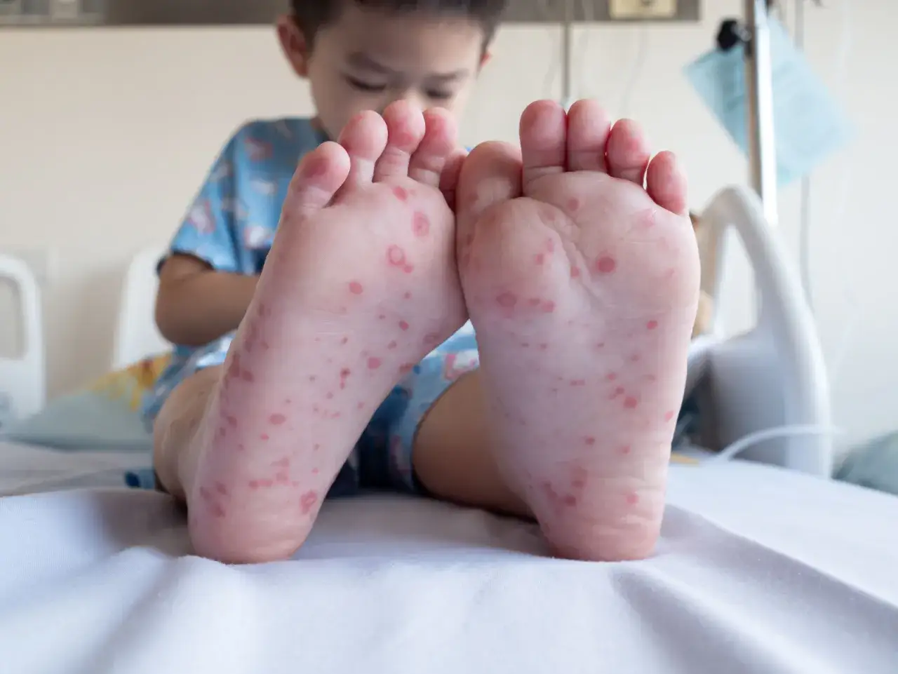 Bambini con macchie rosse su mani, bocca e piedi. Le suole dei piedi sono coperte di piccole eruzioni cutanee.