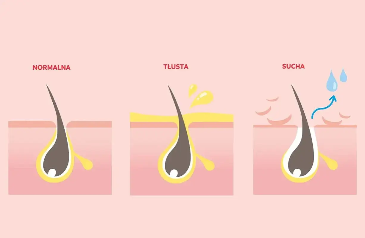Ilustracja pokazuje trzy rodzaje włosów: normalne, tłuste i suche. Włosy tłuste po umyciu nadal wydzielają nadmiar sebum.