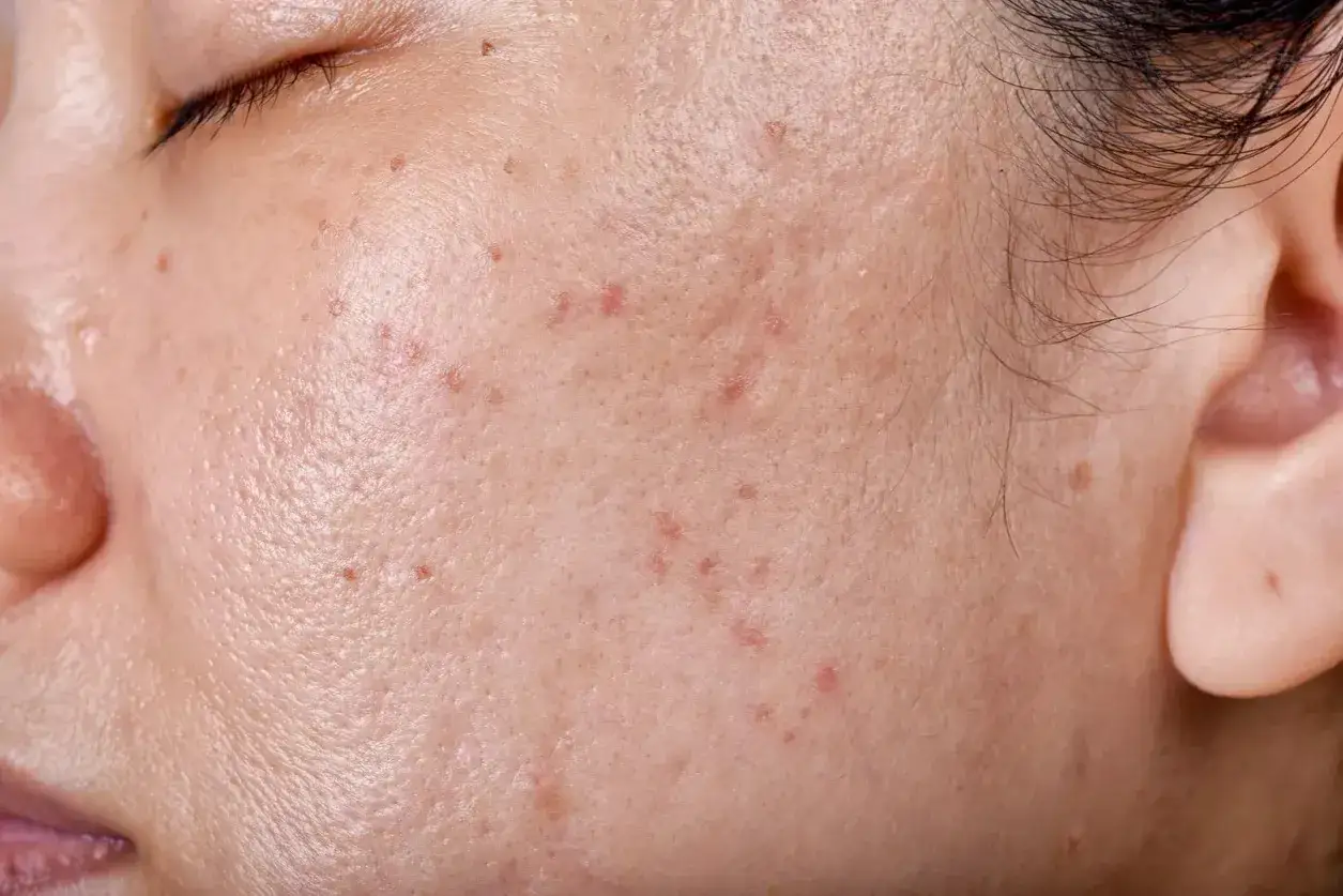 Primer plano de una mejilla con poros dilatados y pequeñas imperfecciones, algunas rojas, que podrían confundirse con verrugas en la cara.