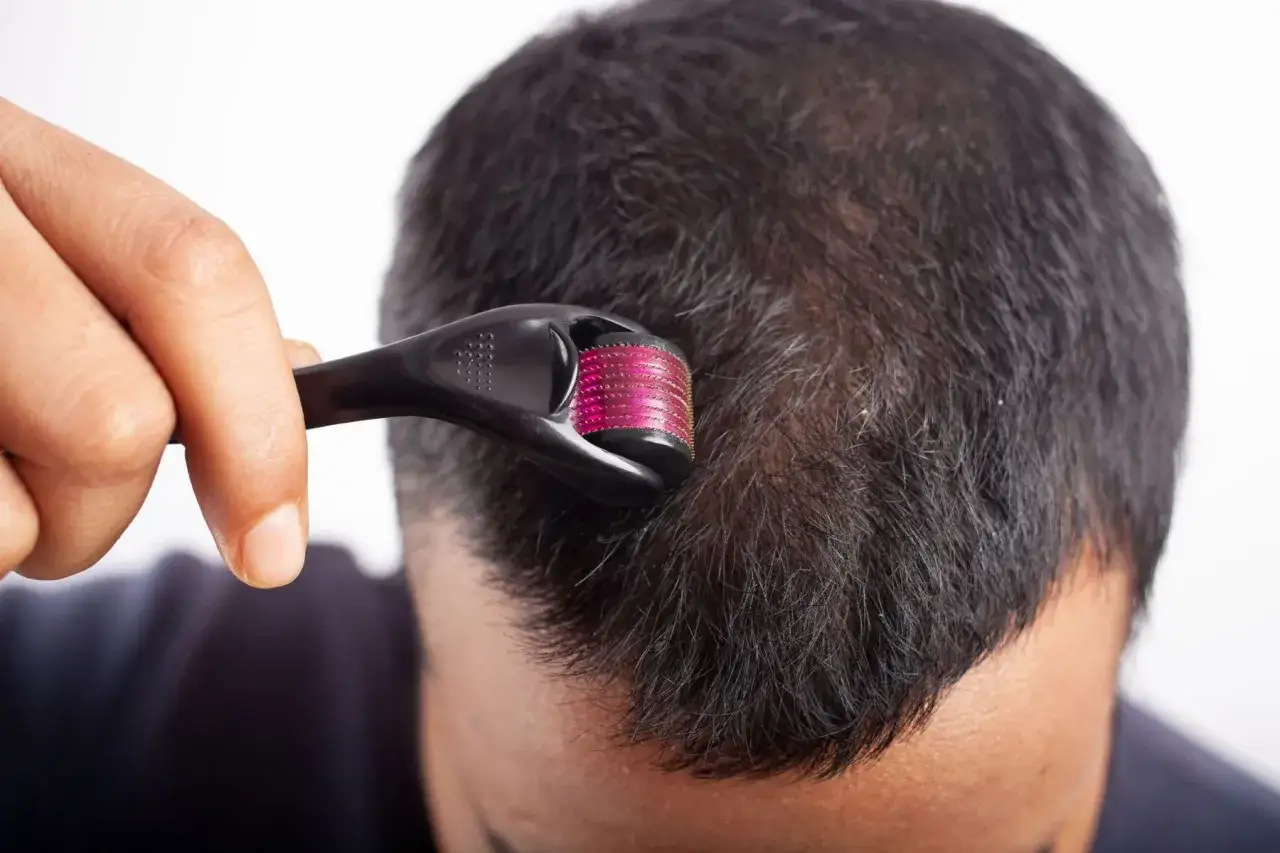 Un homme utilise un dermaroller sur son cuir chevelu, peut-être pour stimuler la croissance des cheveux, en espérant éviter les furterer triphasic progressive effets secondaires.