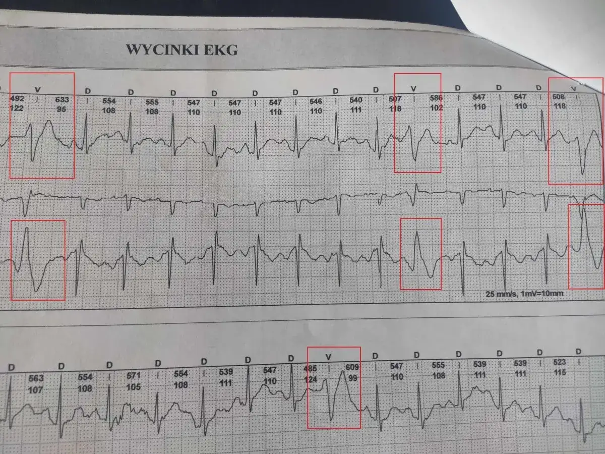Fragment EKG z zaznaczonymi pobudzeniami, wskazującymi na bigeminia komorowa.