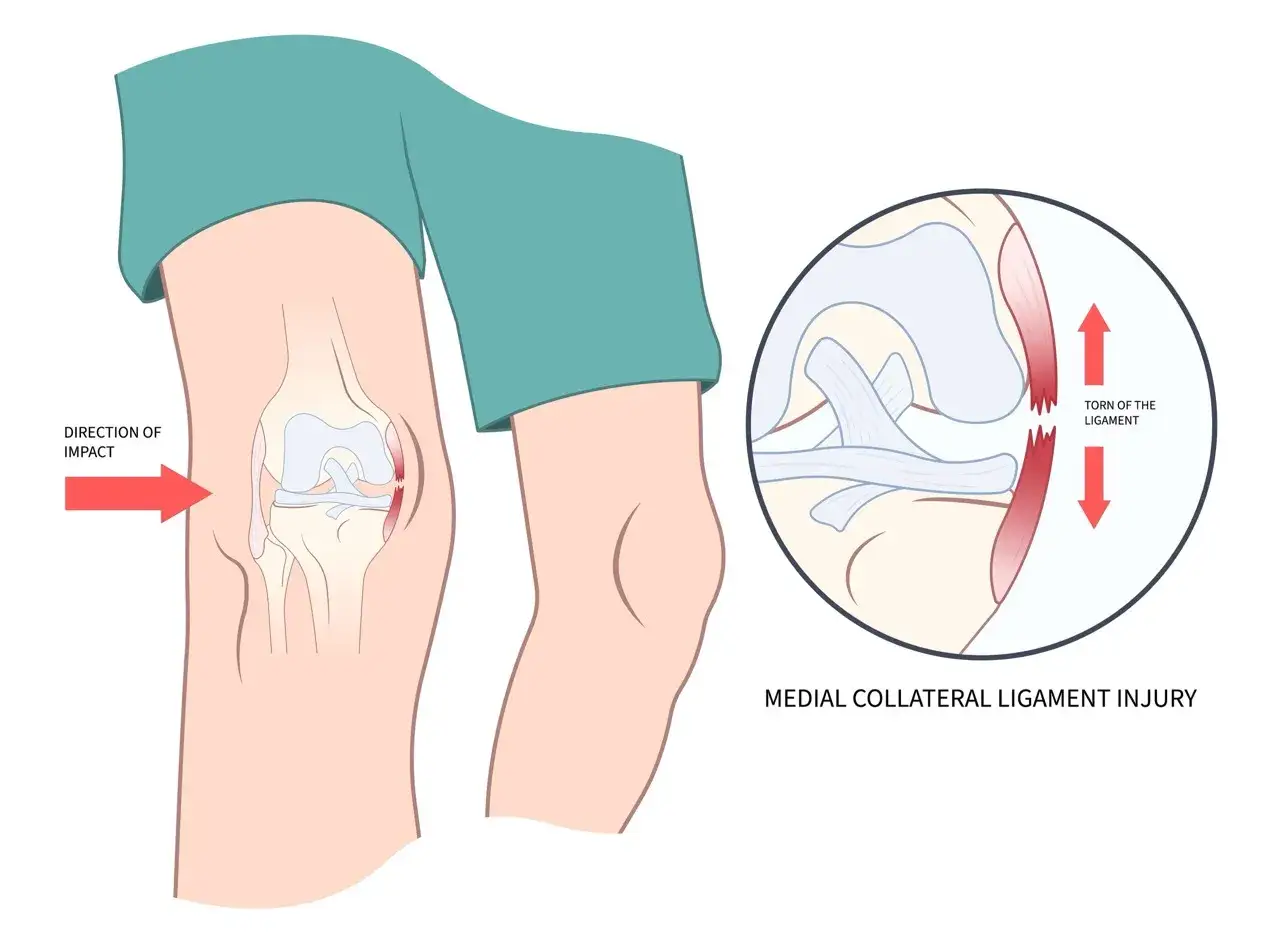 Illustration zeigt einen Innenbandriss Knie nach einem Sto&szlig; von der Seite. Ein vergr&ouml;&szlig;erter Ausschnitt zeigt das gerissene Band.