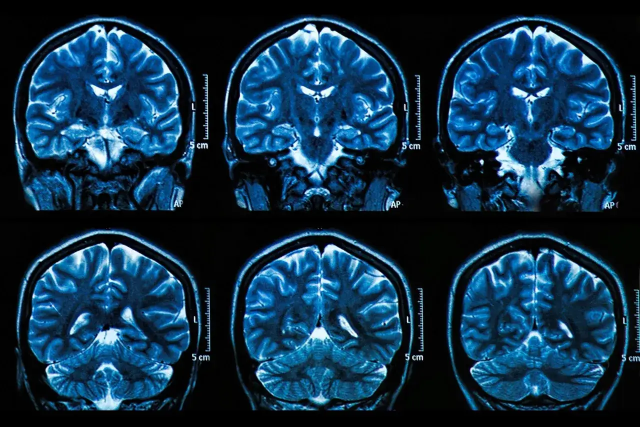 Sei scansioni RM del cervello umano, che mostrano la complessit&agrave; cerebrale, utili per indagare la perdita di memoria a 50 anni.