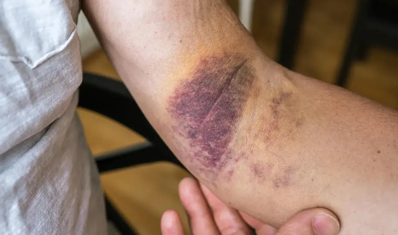 Arm einer Frau mit ausgepr&auml;gten, schnell blauen Flecken, die auf eine Verletzung hindeuten.