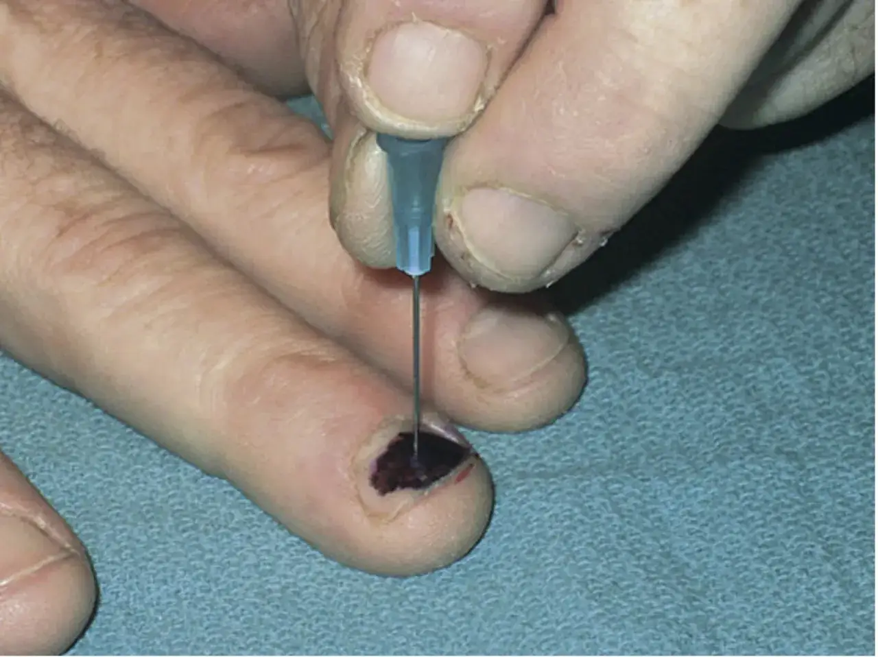 Une aiguille perce un h&eacute;matome sous l'ongle pour soulager la douleur. La dur&eacute;e de la douleur est une pr&eacute;occupation.