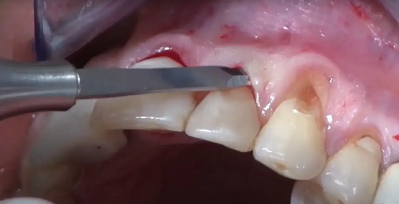 Chirurgiczne przygotowanie miejsca pod przeszczep dziąsła. Widoczne narzędzie dentystyczne i zęby.
