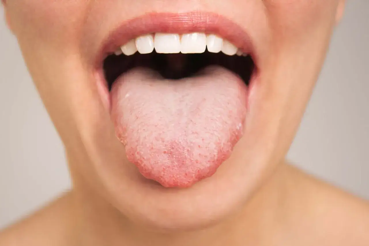 Boca abierta mostrando lengua con manchas rojas y aspecto irritado, sugiriendo dolor de garganta.