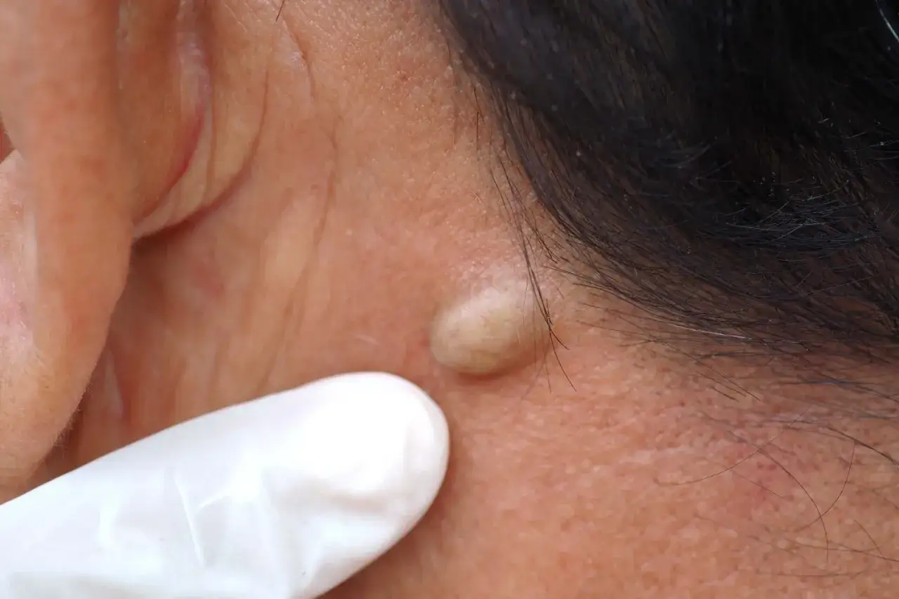 Gros plan sur un micro kyste sur le visage, près de l'oreille. Un doigt ganté blanc examine la petite protubérance cutanée.