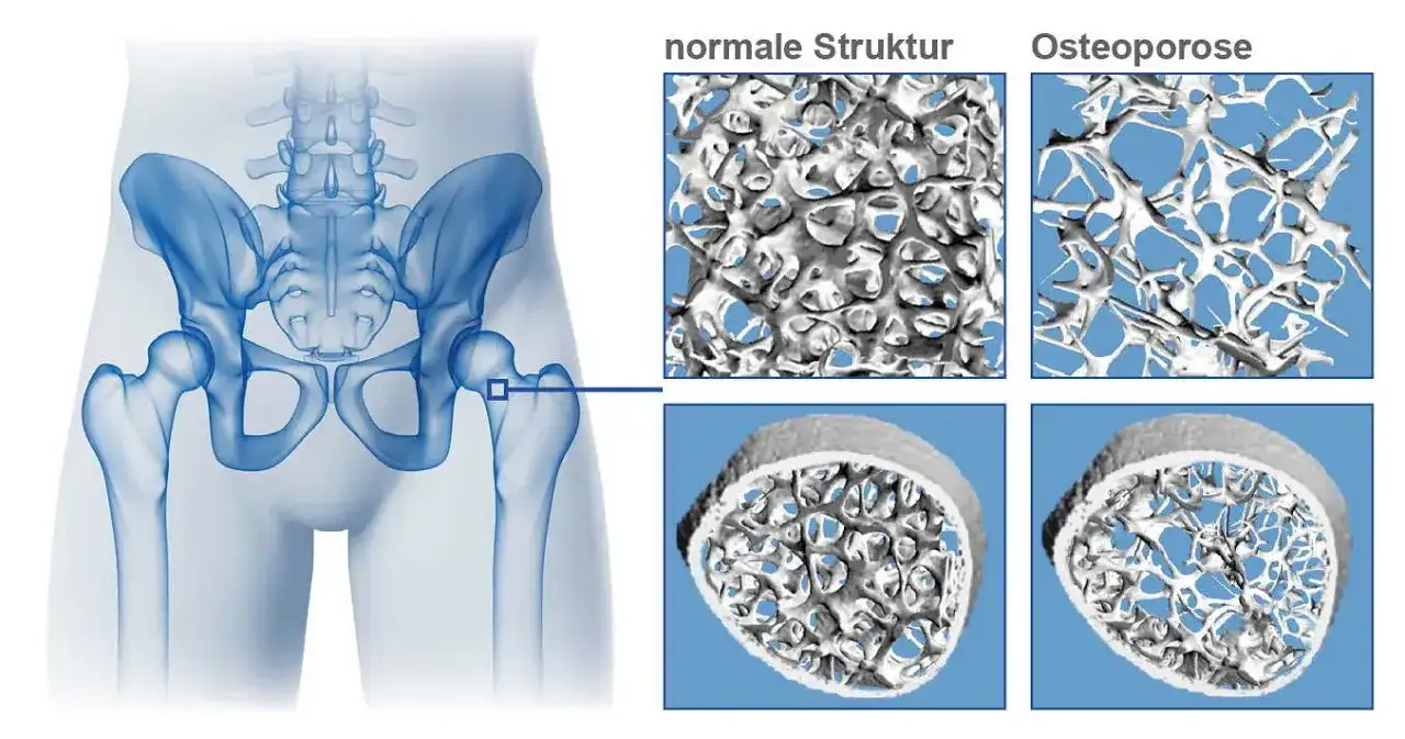 Zdjęcie Dekristol bei Osteoporose auf Kassenrezept: Voraussetzungen und Tipps