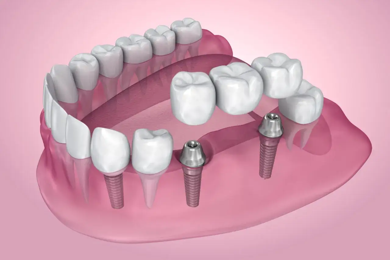 Most adhezyjny na implantach, pokazujący, jak odbudować brakujące zęby.