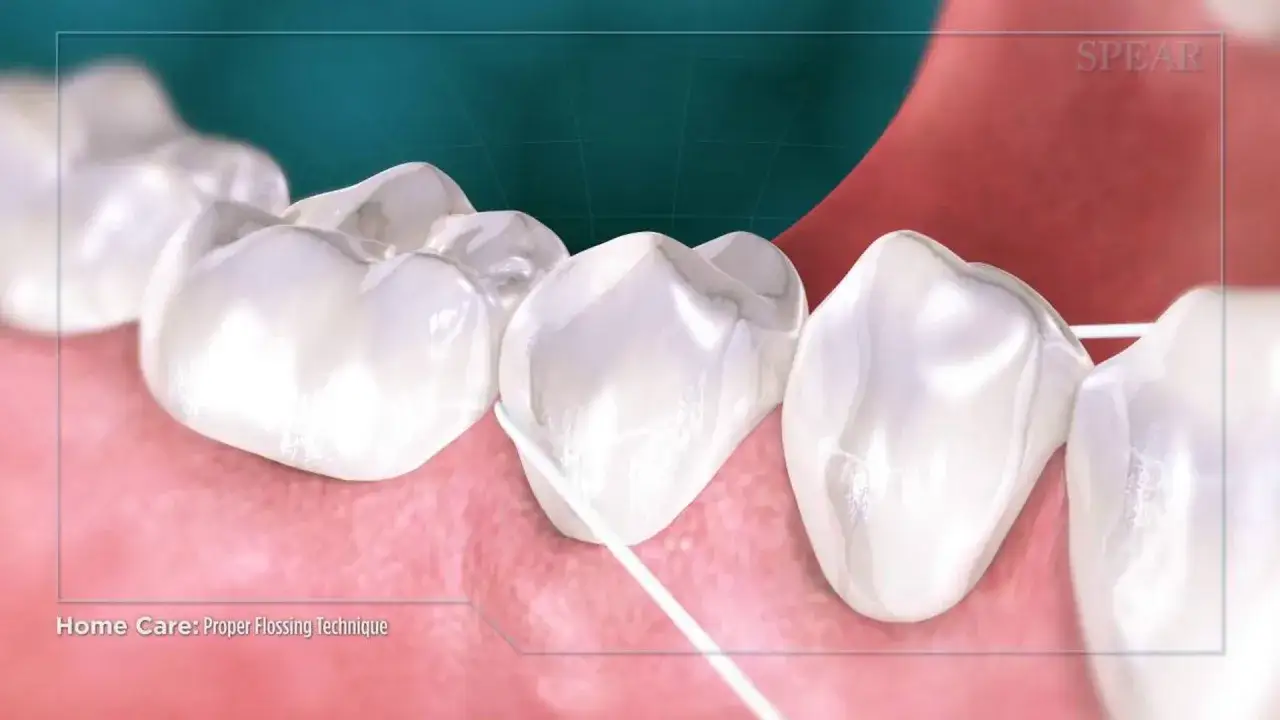 Zbliżenie na zęby, gdzie nić dentystyczna jest używana do nitkowania zębów, pokazując prawidłową technikę czyszczenia przestrzeni międzyzębowych.