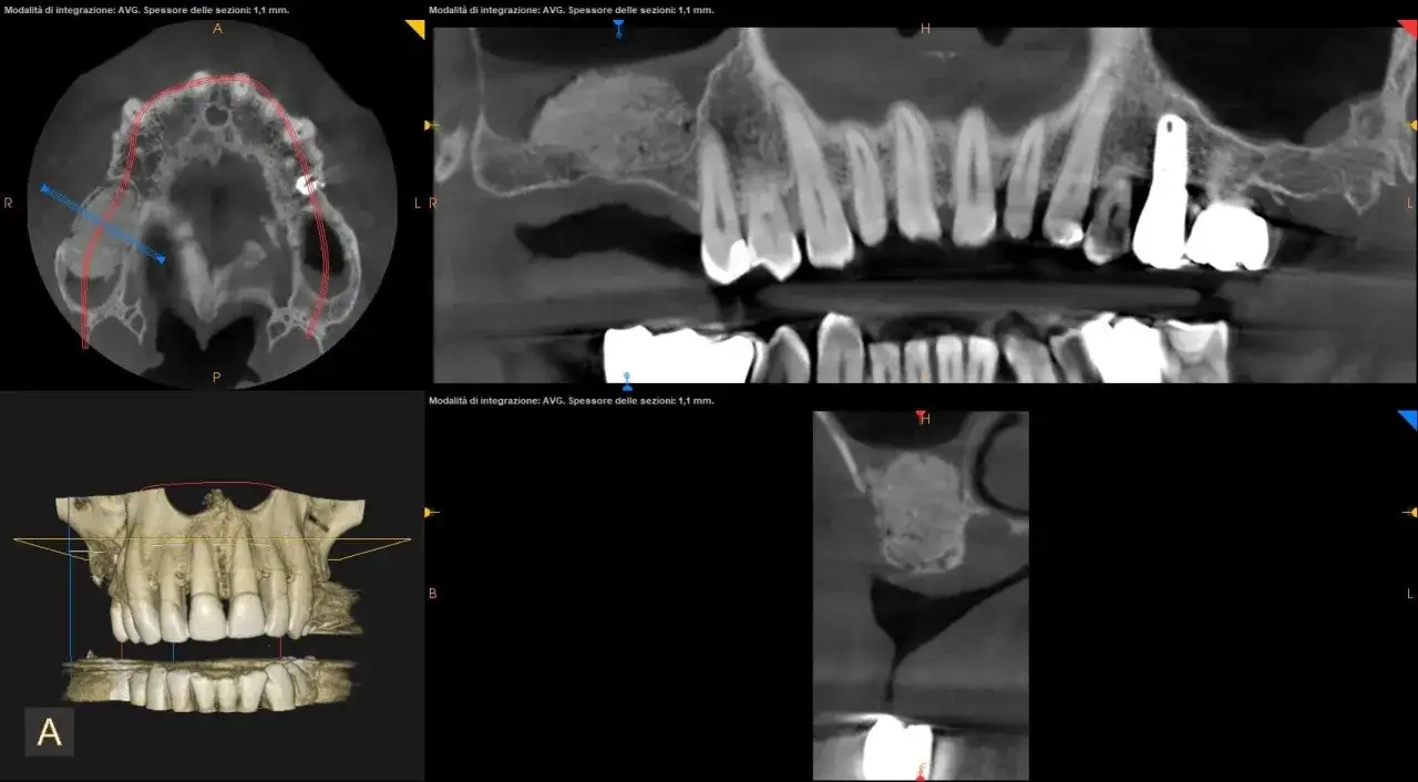Immagini TC dentali che mostrano un rialzo seno mascellare prima e dopo, con innesto osseo e impianto dentale.