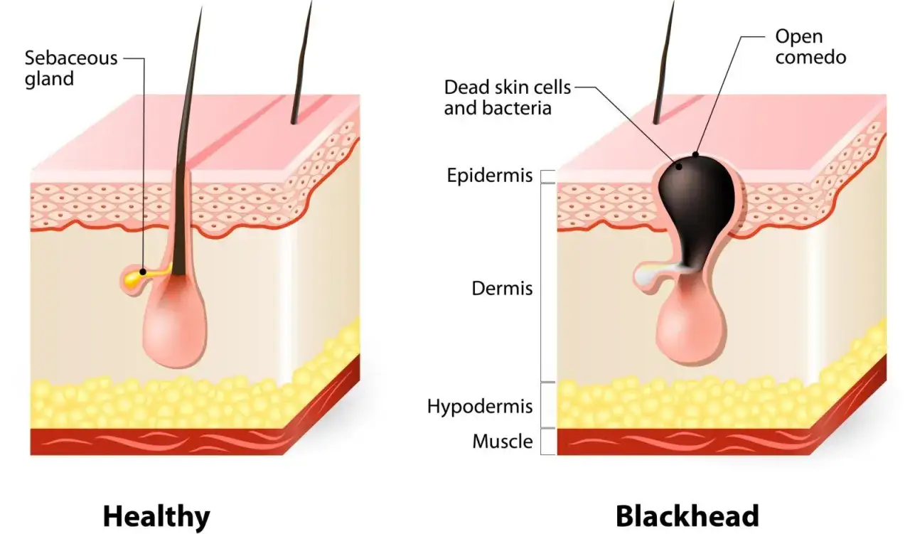 Comparaison peau saine et point noir. Le point noir est un comédon ouvert, résultat de l'accumulation de cellules mortes et de bactéries. L'extraction d'un point noir vise à libérer ce bouchon.
