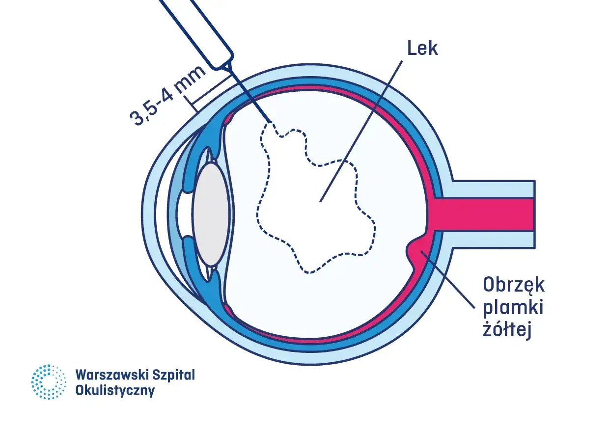 Iniekcja leku do oka, 3,5-4 mm od brzegu rogówki, w celu leczenia obrzęku plamki żółtej.
