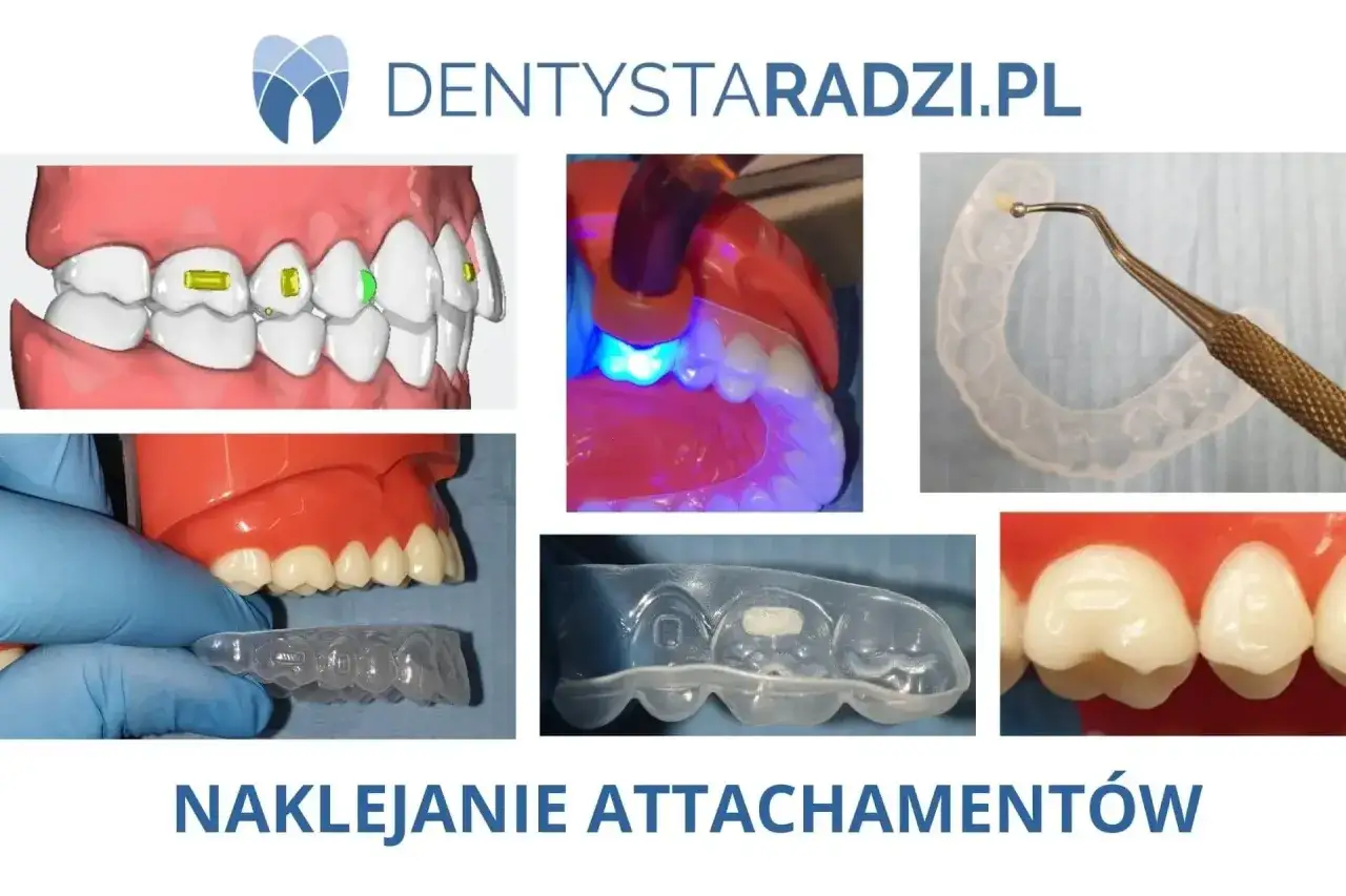 etapy leczenia ortodontycznego krok po kroku
