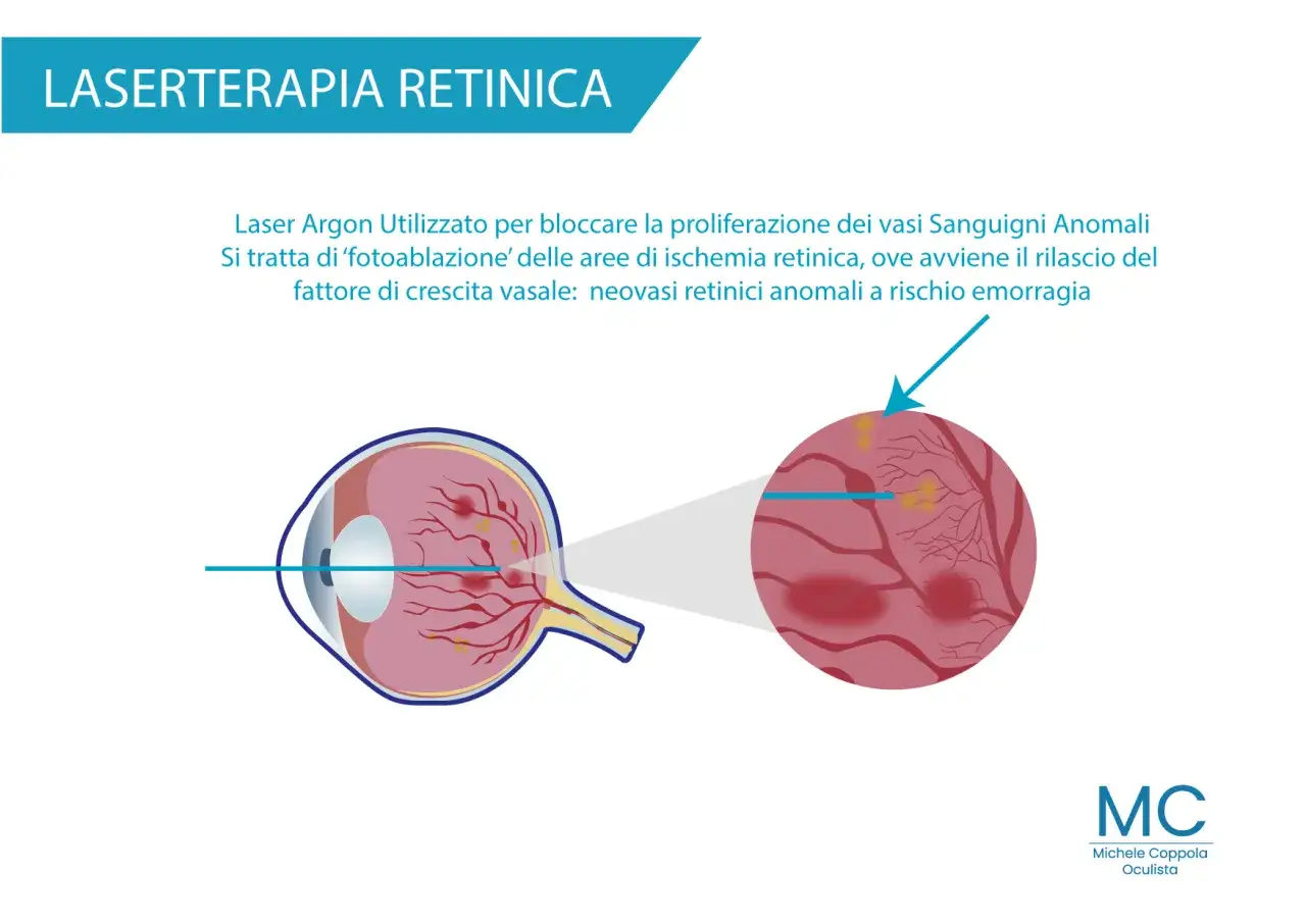Illustrazione di un occhio con un fascio laser che colpisce la retina, bloccando la crescita di vasi sanguigni anomali.