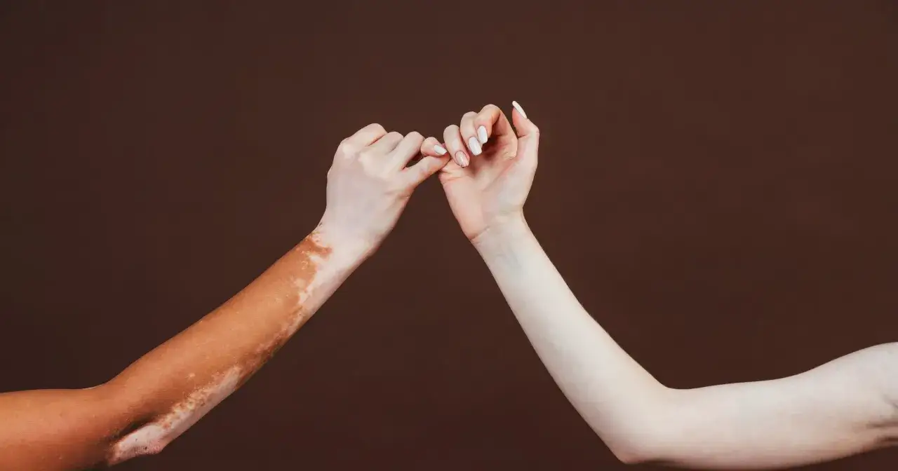 Dwie ręce splatają palce. Jedna z nich ma widoczne plamy **vitiligo**, druga jest gładka.