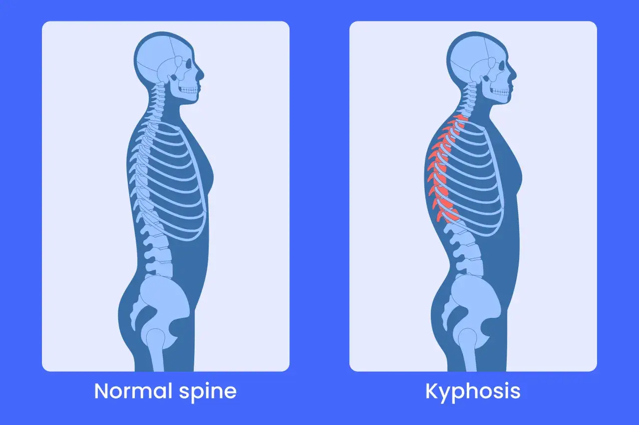 Comparaison de la colonne vertébrale : une posture normale et une cyphose dorsale accentuée, où le dos est courbé.