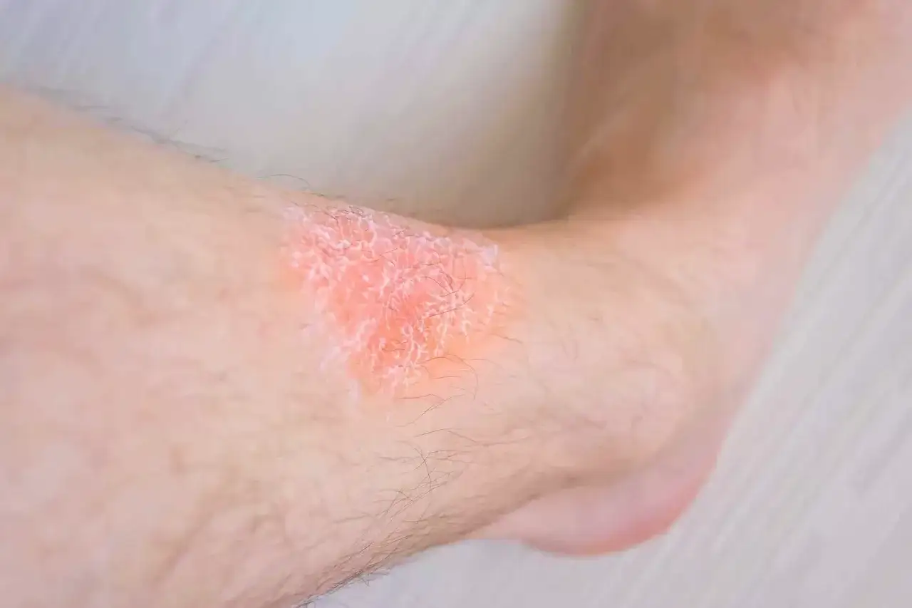 Plaque rouge et squameuse sur la cheville, causant des d&eacute;mangeaisons aux jambes le soir.